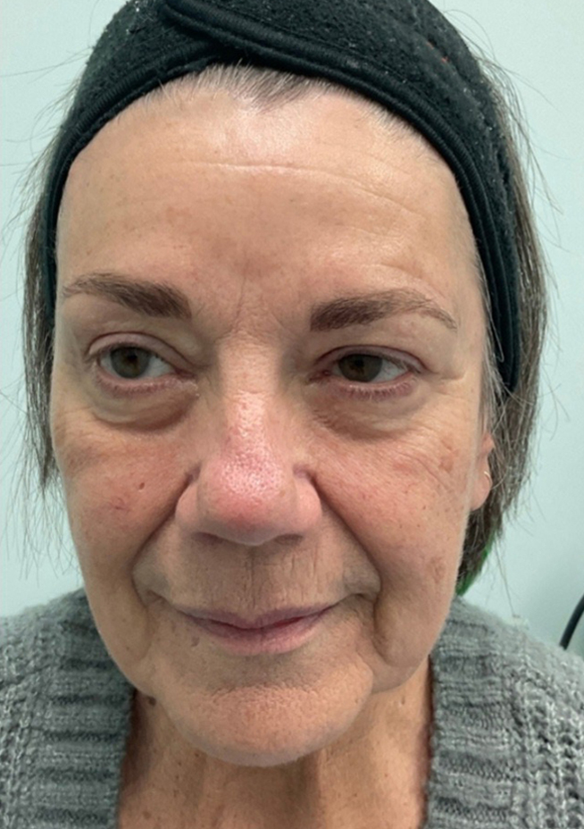 Before Image: Anti-Aging Protocol - front