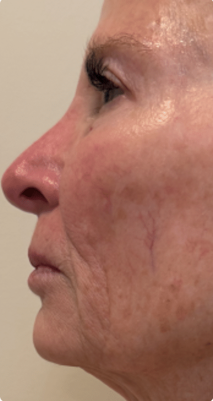 After Image: T-Shape 2 - left-side