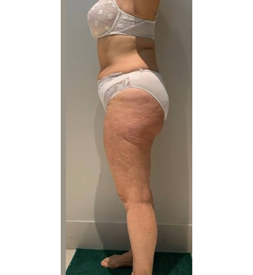 Before Image: T-Shape 2 - left-side