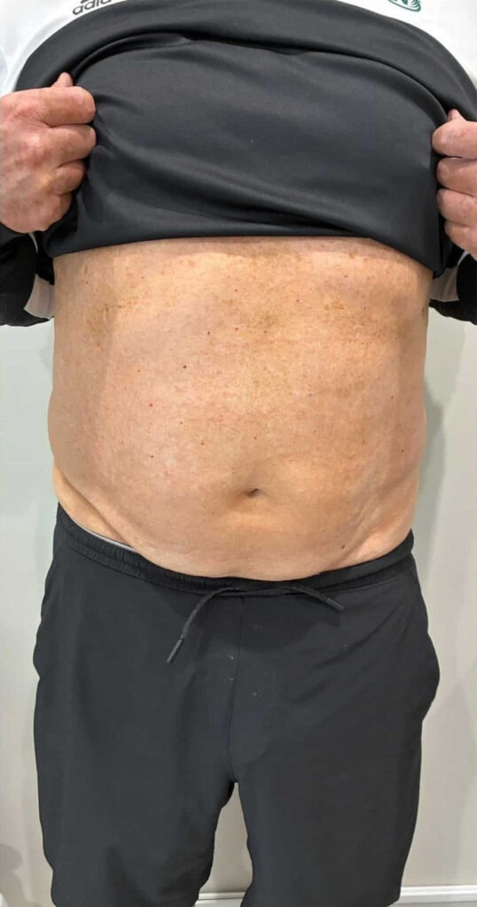 Before Image: T-Shape 2 - front