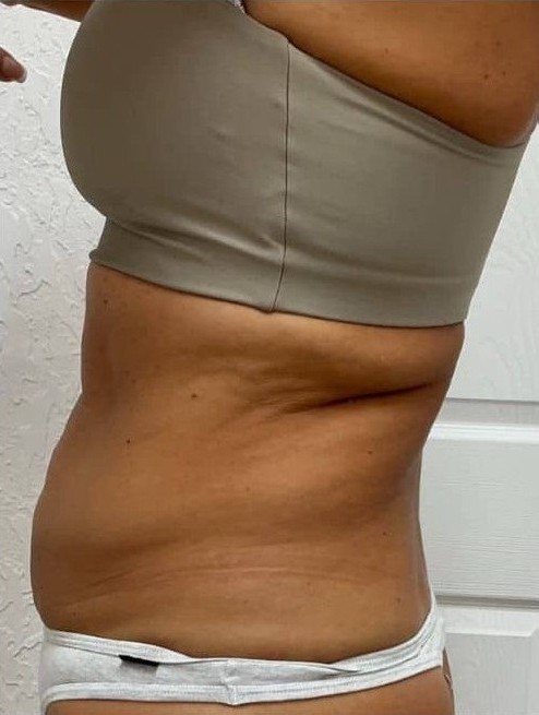Before Image: T-Shape 2 - left-side