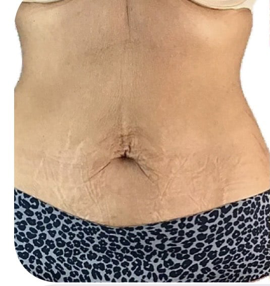 Before Image: T-Shape 2 - front